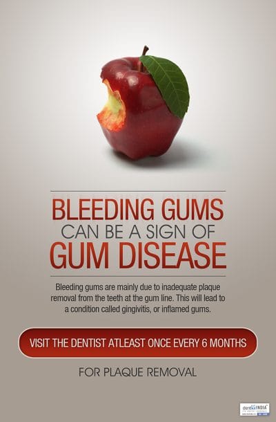 Bleeding gums may indicate gum disease educational poster