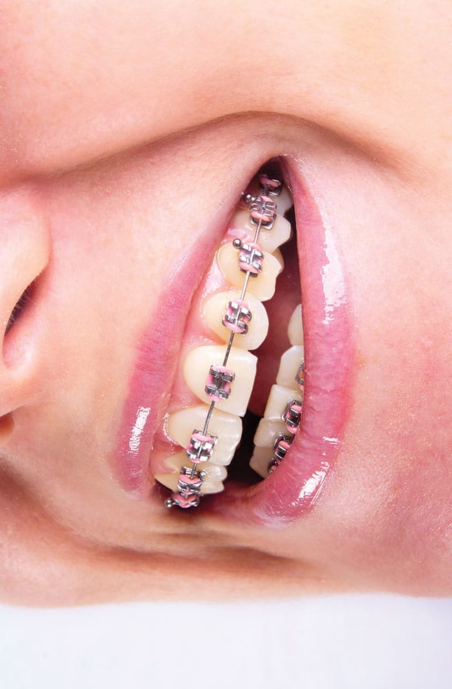 Dental braces orthodontic treatment close up poster