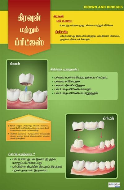 Tamil dental awareness poster explaining dental crowns and bridges used to restore damaged and missing teeth