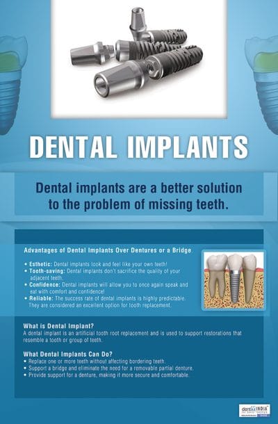 Dental implants educational poster for missing teeth replacement
