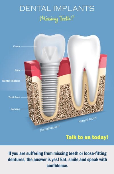 Dental implants for replacing missing teeth poster