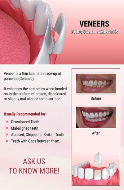 Dental veneers cosmetic dentistry before and after poster