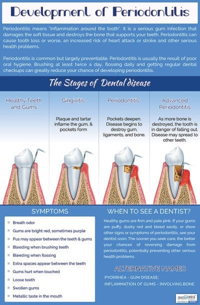 Stages in the development of periodontitis dental poster
