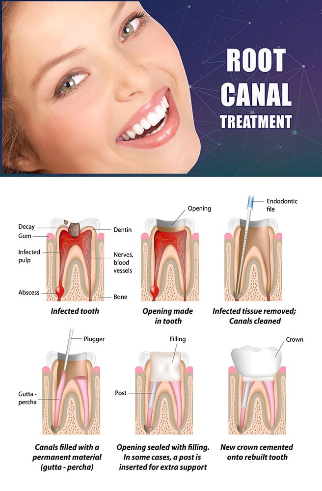 Root canal treatment procedure and tooth anatomy poster