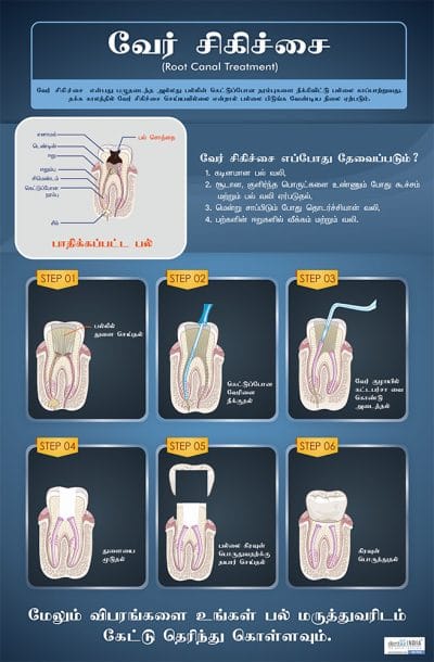 Tamil dental poster explaining the root canal treatment procedure with six illustrated steps