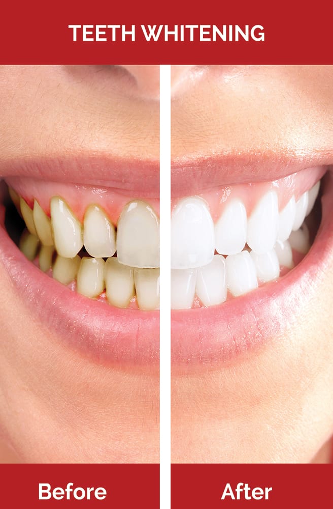 Teeth whitening before and after cosmetic dentistry poster