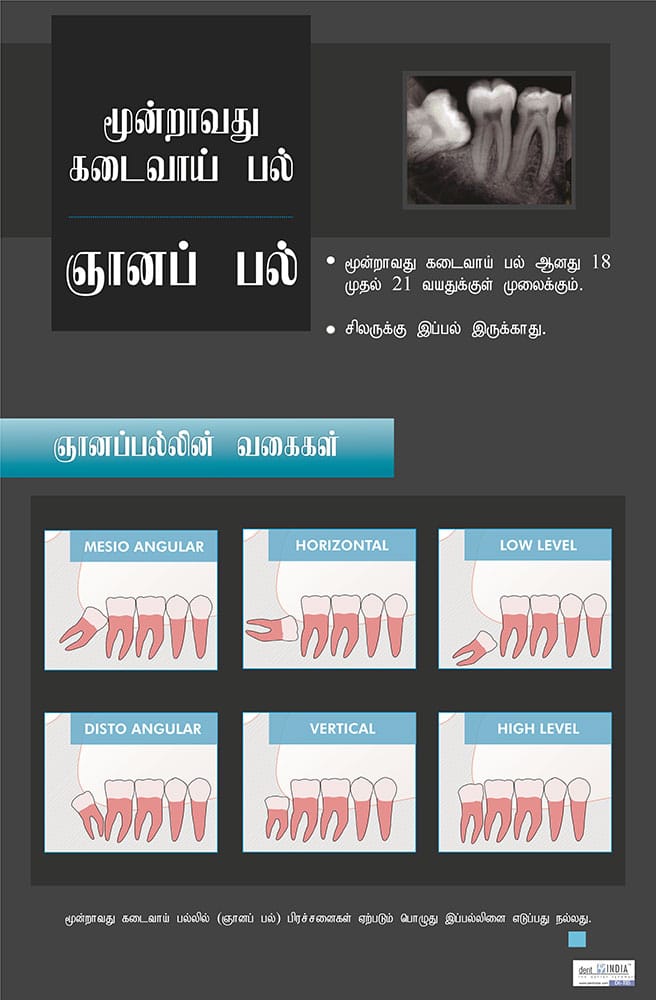 Tamil dental poster illustrating different types of impacted wisdom teeth